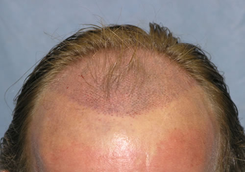 Tiny recipient sites - Hair Transplantation, Hair Restoration