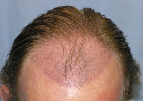 Spacing of hair transplant recipient sites