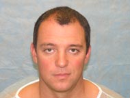 Before Hair Transplant - Adam Khoudja - Bernstein Medical
