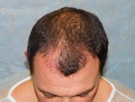 Before Hair Transplant - Adam Khoudja - Bernstein Medical