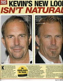 Celebrity Hair Transplants - Kevin Costner