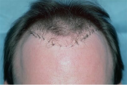 Bad Hair Transplant - Row of large grafts transplanted in early 1990s