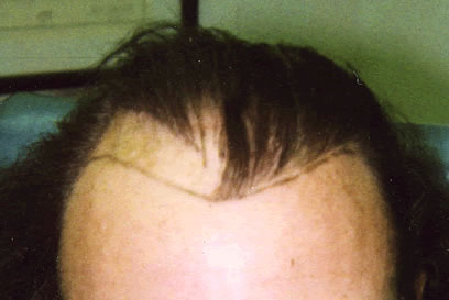 Before Combined Hair Transplant Repair