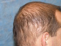 Diffuse Unpatterned Alopecia (DUPA) in a 32 year-old male