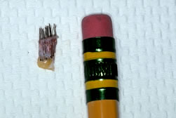 4-mm Punch Graft and Pencil Eraser