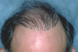 Guide to Hair Restoration - Pluggy look typical of the older hair transplant procedures