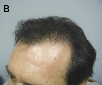 Follicular Unit Extraction - Six months after 2 sessions of follicular unit extraction hair transplant spaced 12 days apart