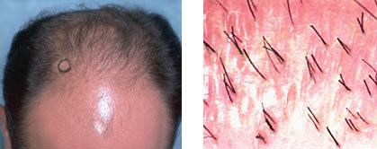 Most Hair Miniaturized in Thinning Area
