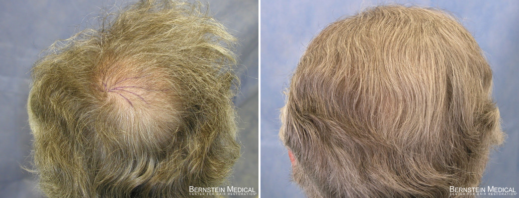 propecia reverse hair miniaturization temples propecia reverse hair miniaturization temples