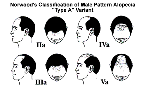 Guide to Hair Restoration - Norwood Classification of Male Pattern Alopecia Type A Variant