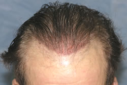 Second Hair Transplant - Recipient Sites