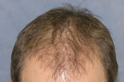 2 Weeks After Hair Transplant - Top View
