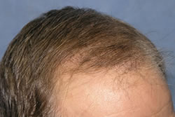 1 Week After Hair Transplant - Side Angle