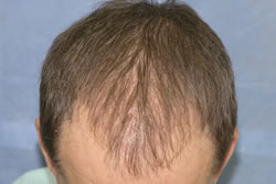2 Weeks After Hair Restoration Surgery - Top View