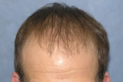 2 Months After Hair Restoration - Top View