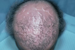 Bad Hair Transplant - Scarring from Artificial Hair Fibers
