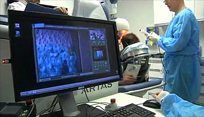 Dr. Bernstein discusses ARTAS Robotic FUE system on NY1