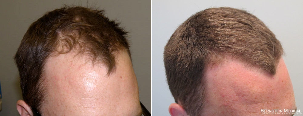 Before And After 5s. After 5 months on finasteride