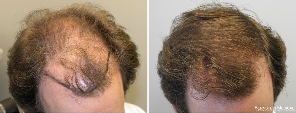 rogaine results pictures bernsteinmedical.com