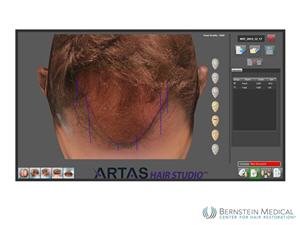 The ARTAS Robotic System maps the surgeon's hairline design onto a 3-D model of the patient's head