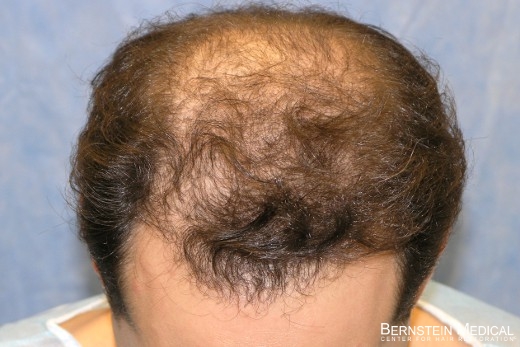 Before Hair Transplant - Top View