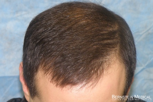 After 1st Hair Transplant Session - Top View
