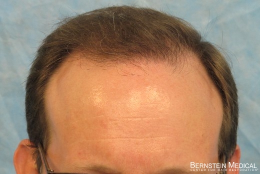 After 1st Hair Transplant Session