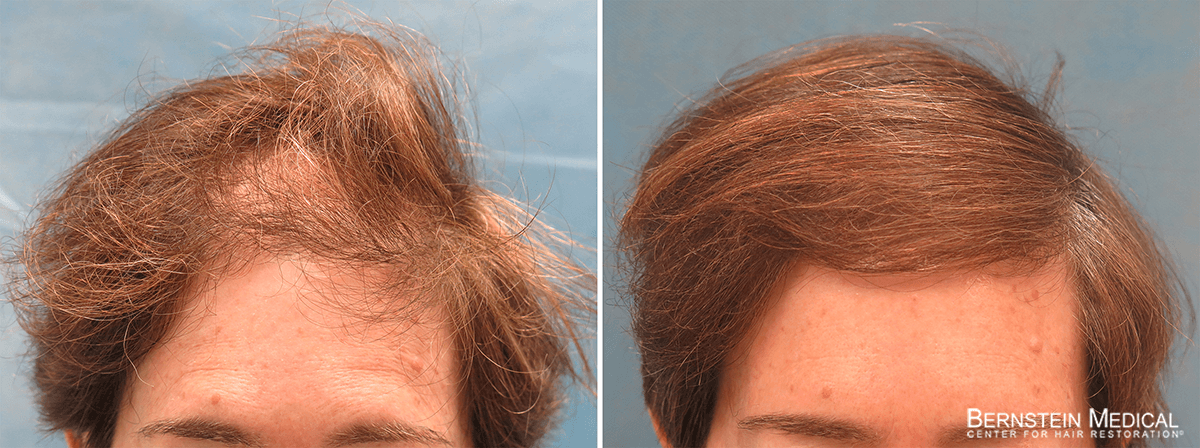 Bernstein Medical - Patient QMI Before and After Hair Transplant Photo 