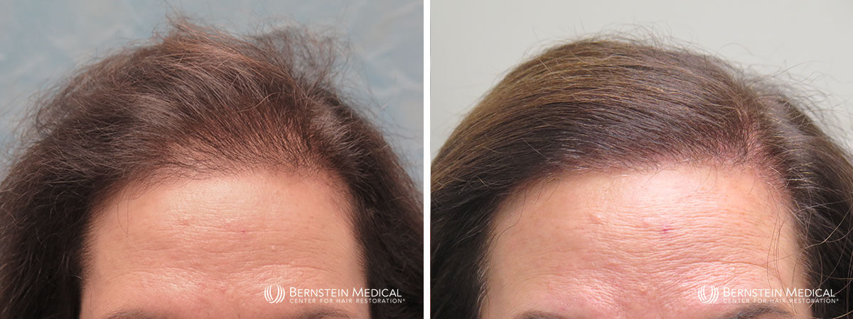 Bernstein Medical - Patient ERC Before and After Hair Transplant Photo 