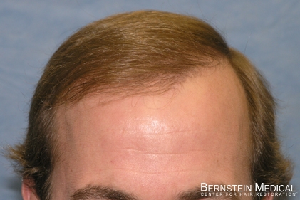After 1st Hair Transplant Session