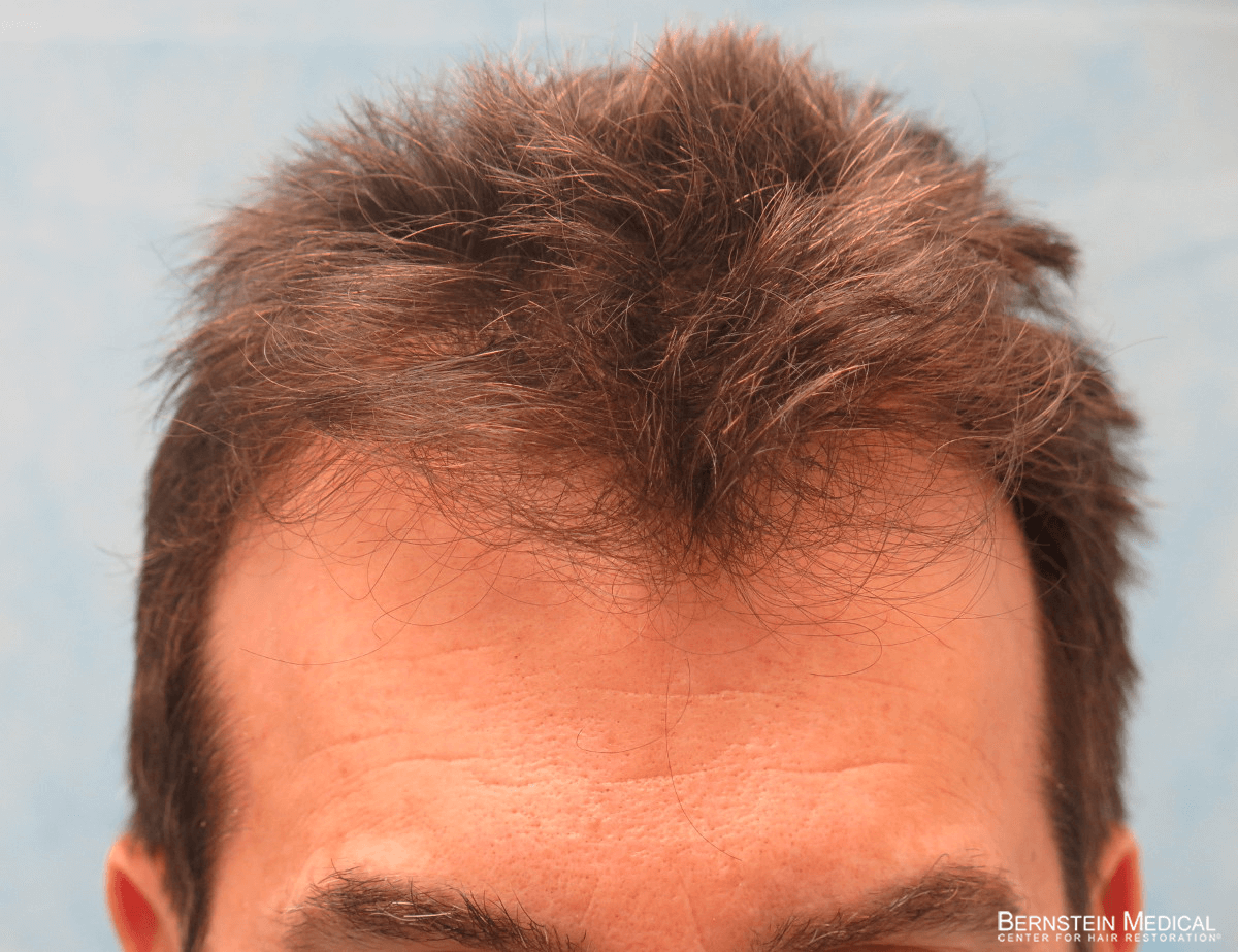 Patient ESR | Bernstein Medical - Center for Hair Restoration
