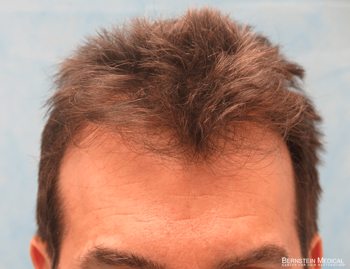 Patient ESR | Bernstein Medical - Center for Hair Restoration Patient ESR | Bernstein Medical - Center for Hair Restoration