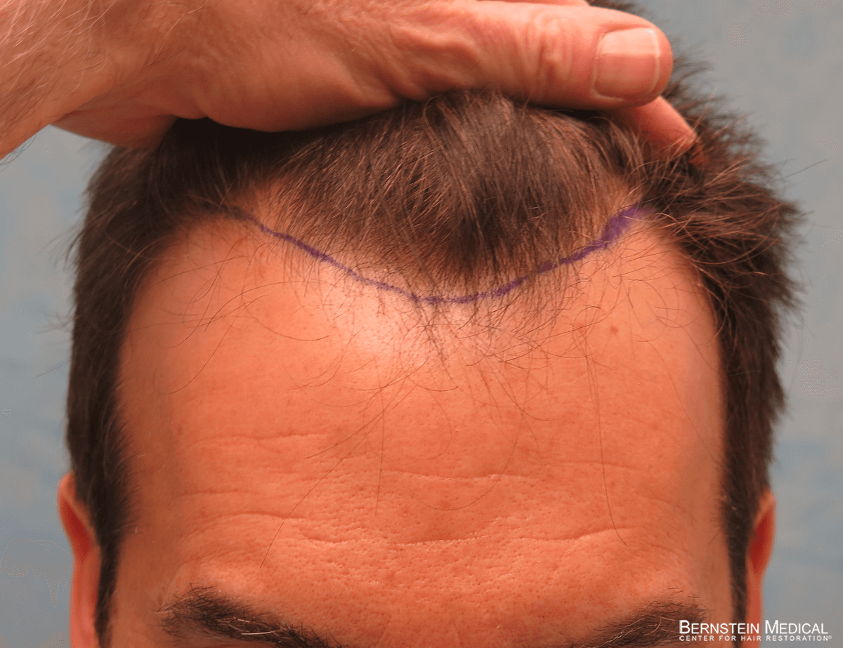 Patient ESR | Bernstein Medical - Center for Hair Restoration