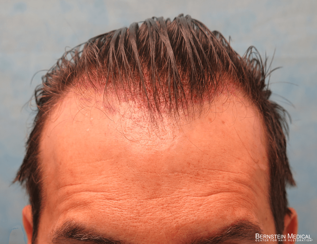 Patient ESR | Bernstein Medical - Center for Hair Restoration Patient ESR | Bernstein Medical - Center for Hair Restoration