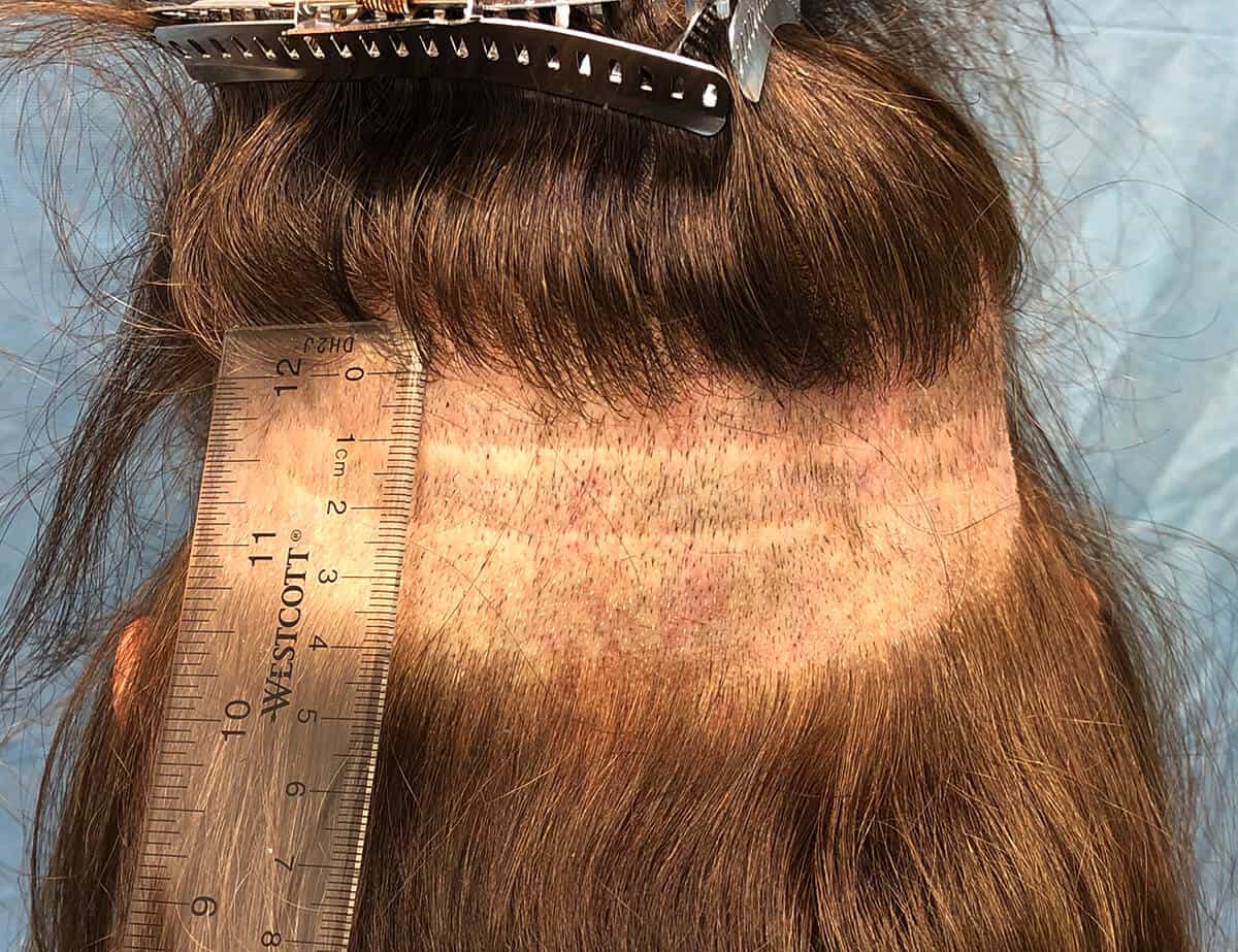 4 cm Wide Band Shaved Showing Old Strip Scars