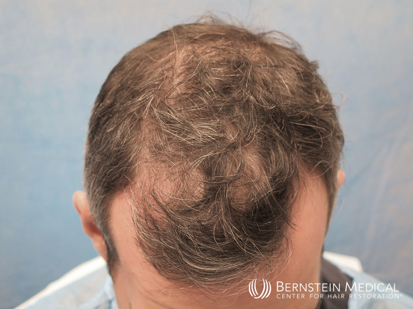 Patient DXL | Bernstein Medical - Center for Hair Restoration Patient DXL | Bernstein Medical - Center for Hair Restoration