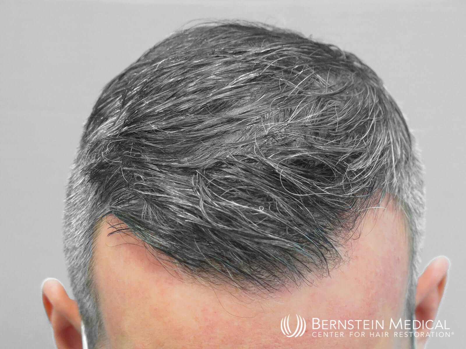Patient DXL | Bernstein Medical - Center for Hair Restoration