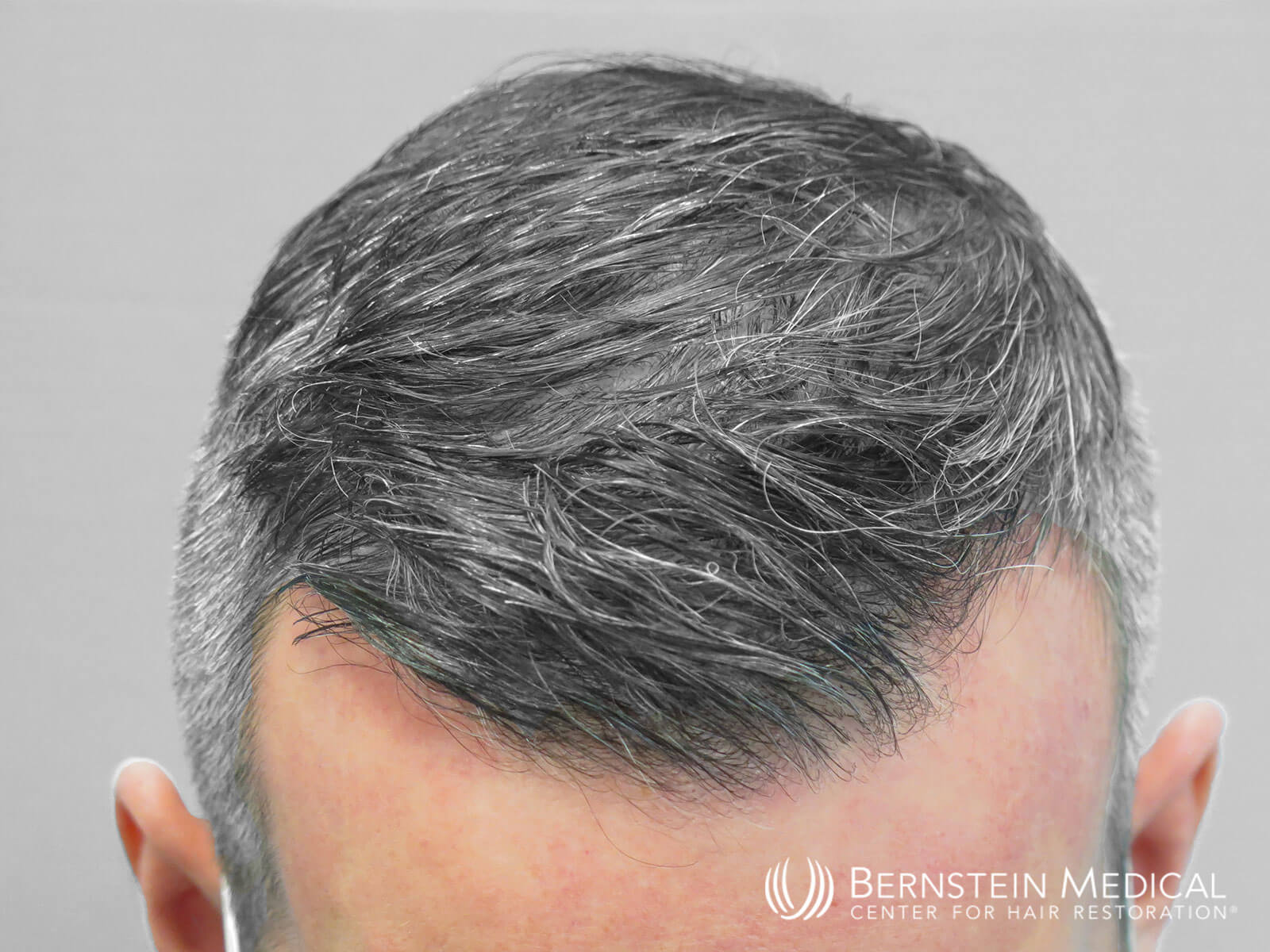 Patient DXL | Bernstein Medical - Center for Hair Restoration Patient DXL | Bernstein Medical - Center for Hair Restoration