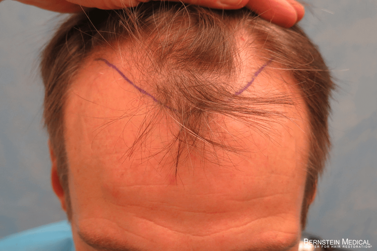 Patient LKI | Bernstein Medical - Center for Hair Restoration