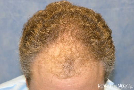 Before Hair Transplant - Top View