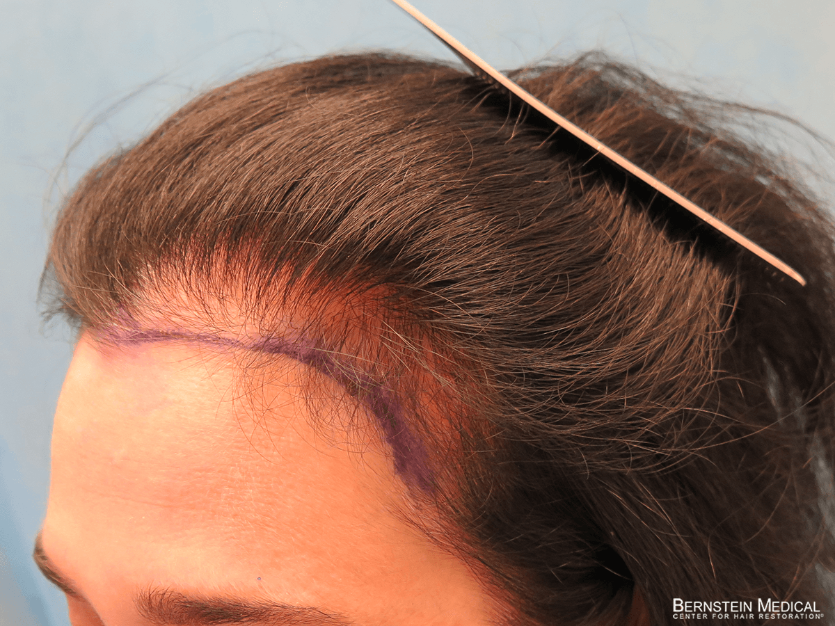Patient ABN | Bernstein Medical - Center for Hair Restoration Patient ABN | Bernstein Medical - Center for Hair Restoration