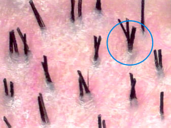 New Instrumentation for 3-step Follicular Unit Extraction - Follicular units well-demarcated on the surface of the scalp