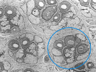 New Instrumentation for 3-step Follicular Unit Extraction - The punch fitting neatly around a 3-hair follicular unit at the level of the mid-dermis