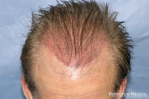 Recipient Sites Hair Transplant Surgery | Bernstein Medical Recipient Sites Hair Transplant Surgery | Bernstein Medical