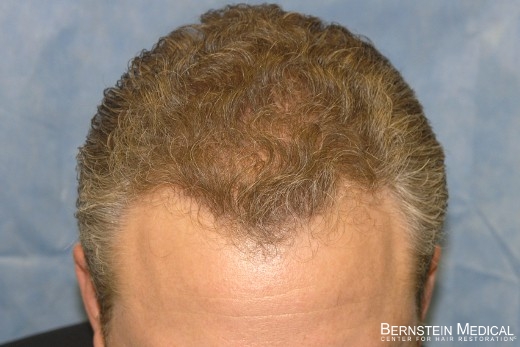 After Hair Transplant - Top View