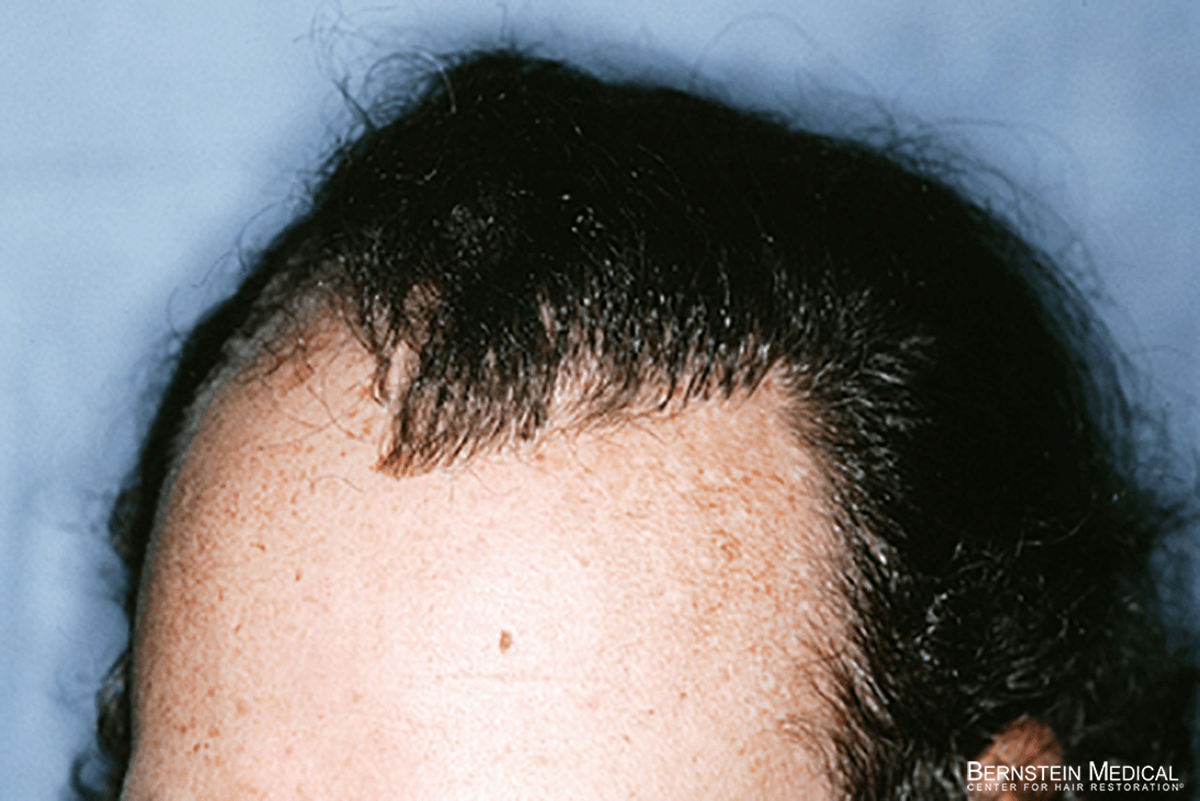 Patient RGL | Bernstein Medical - Center for Hair Restoration