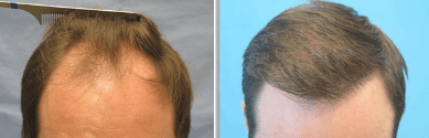 Bernstein Medical - Patient RQZ Before and After Hair Transplant Photo