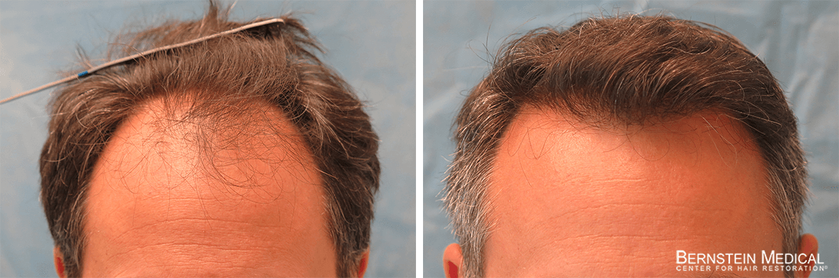 Bernstein Medical - Patient BLI Before and After Hair Transplant Photo 