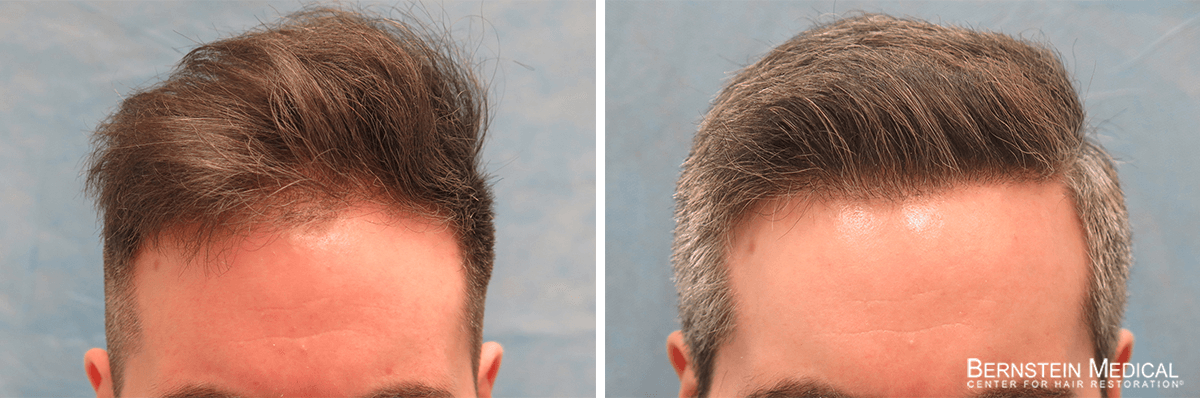 Bernstein Medical - Patient COF Before and After Hair Transplant Photo 