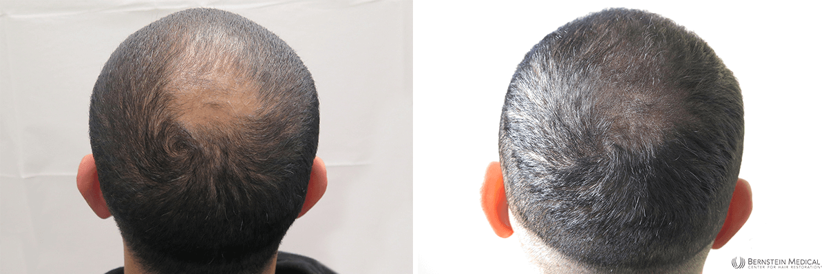 Bernstein Medical - Patient CWF Before and After Hair Transplant Photo
